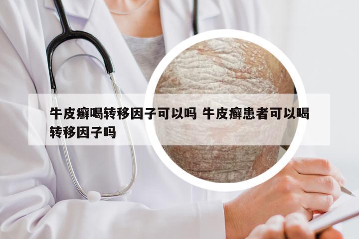 牛皮癣喝转移因子可以吗 牛皮癣患者可以喝转移因子吗