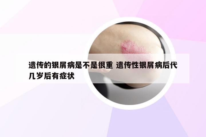 遗传的银屑病是不是很重 遗传性银屑病后代几岁后有症状