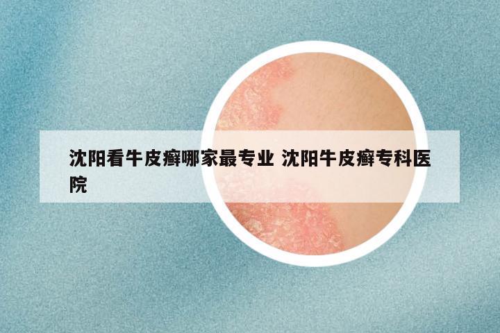 沈阳看牛皮癣哪家最专业 沈阳牛皮癣专科医院