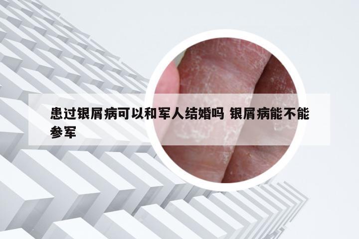 患过银屑病可以和军人结婚吗 银屑病能不能参军