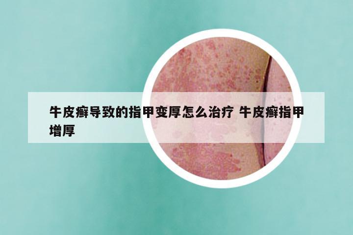 牛皮癣导致的指甲变厚怎么治疗 牛皮癣指甲增厚