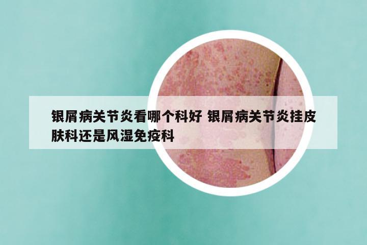 银屑病关节炎看哪个科好 银屑病关节炎挂皮肤科还是风湿免疫科