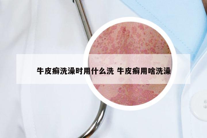 牛皮癣洗澡时用什么洗 牛皮癣用啥洗澡