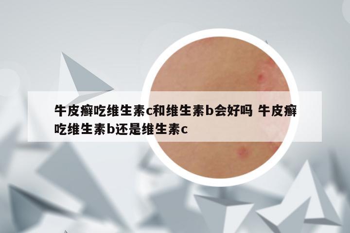 牛皮癣吃维生素c和维生素b会好吗 牛皮癣吃维生素b还是维生素c