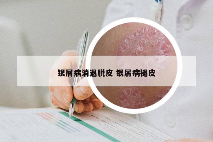 银屑病消退脱皮 银屑病褪皮