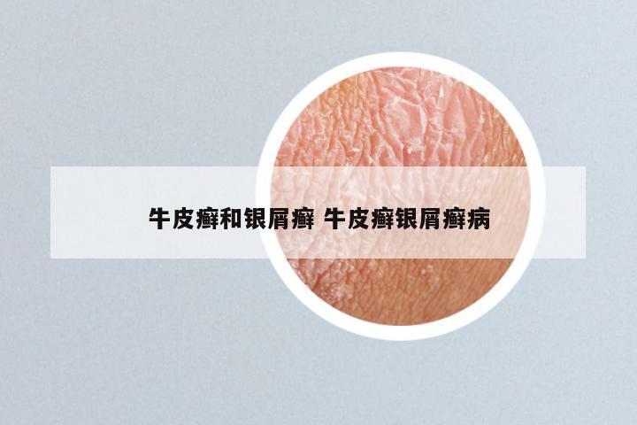 牛皮癣和银屑癣 牛皮癣银屑癣病