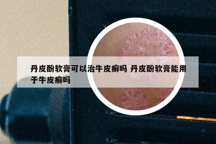 丹皮酚软膏可以治牛皮癣吗 丹皮酚软膏能用于牛皮癣吗