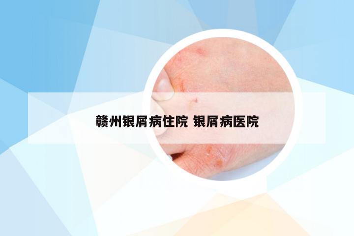 赣州银屑病住院 银屑病医院