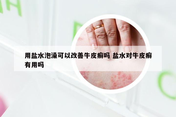 用盐水泡澡可以改善牛皮癣吗 盐水对牛皮癣有用吗