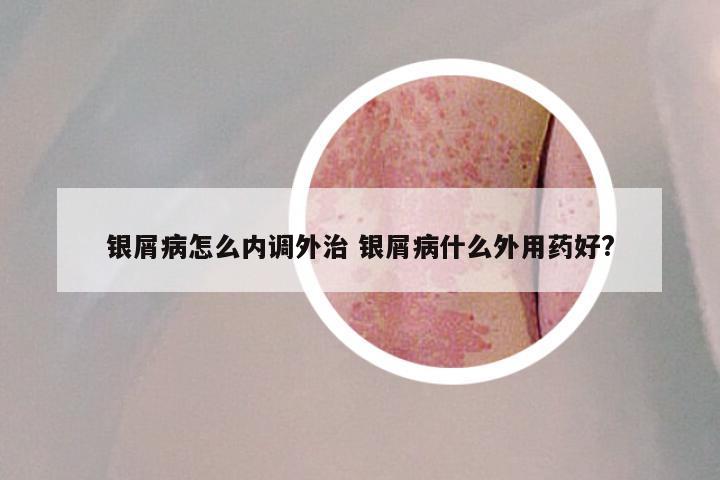 银屑病怎么内调外治 银屑病什么外用药好?
