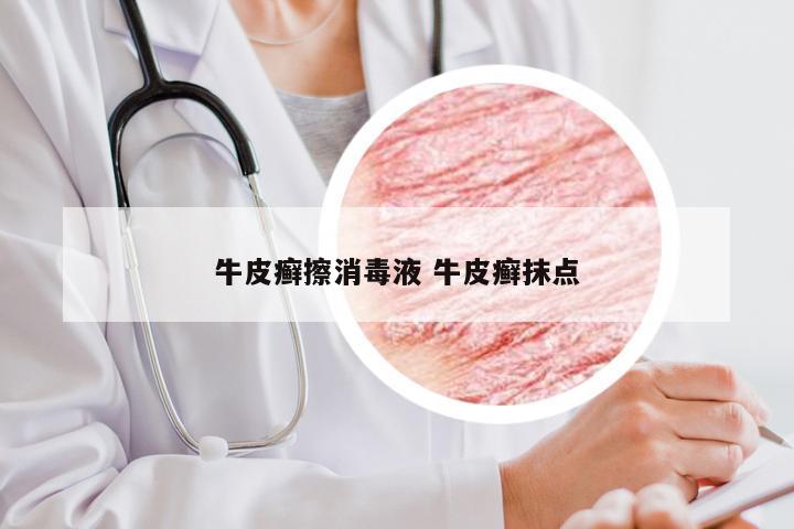 牛皮癣擦消毒液 牛皮癣抹点