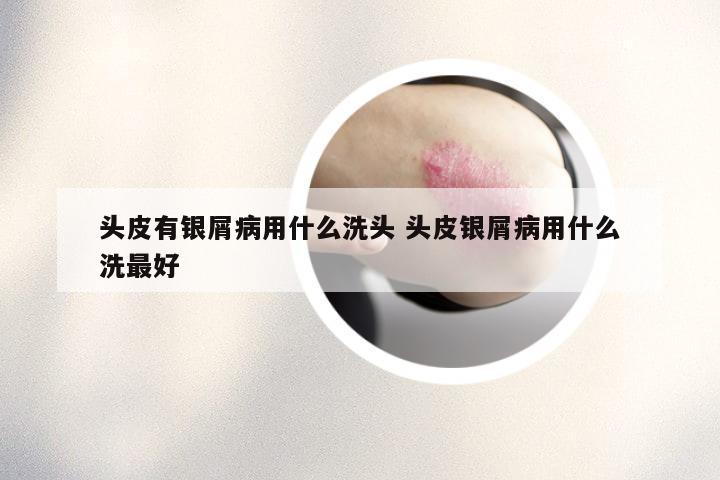 头皮有银屑病用什么洗头 头皮银屑病用什么洗最好