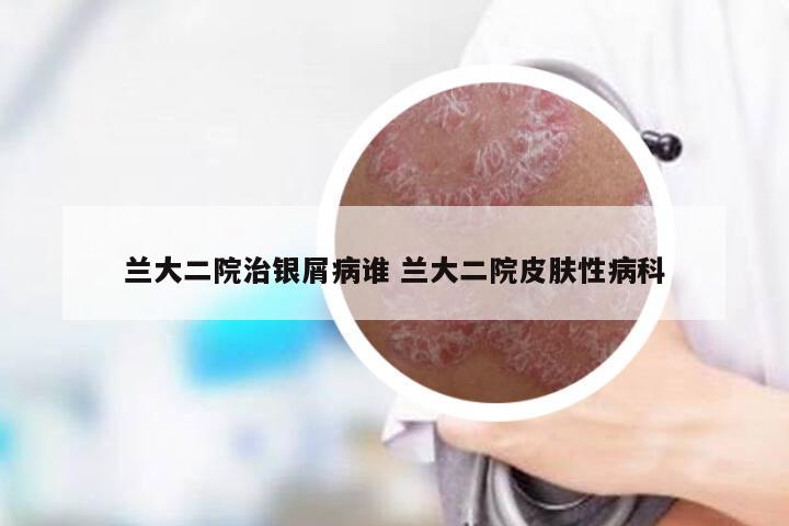 兰大二院治银屑病谁 兰大二院皮肤性病科