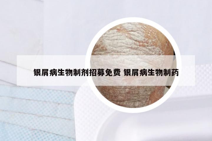 银屑病生物制剂招募免费 银屑病生物制药