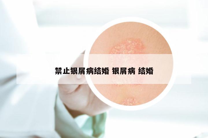 禁止银屑病结婚 银屑病 结婚