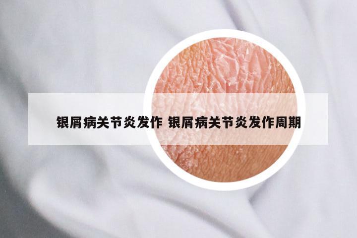 银屑病关节炎发作 银屑病关节炎发作周期