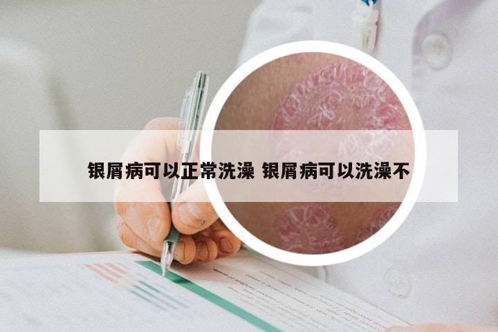 银屑病可以正常洗澡 银屑病可以洗澡不