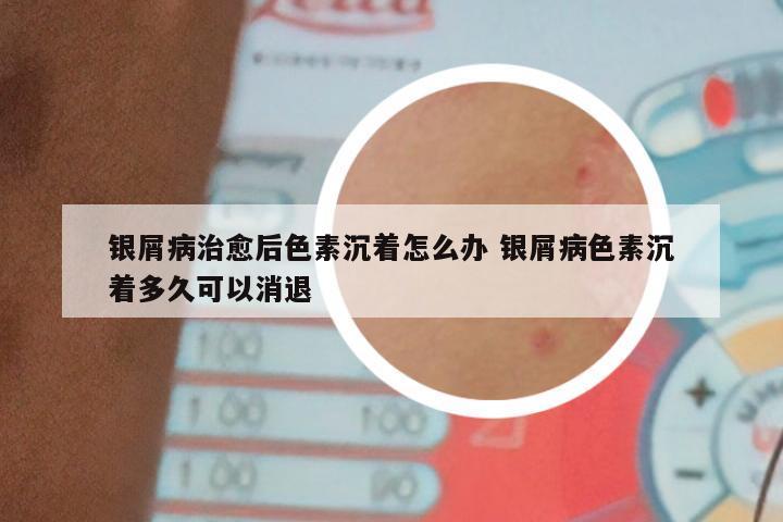 银屑病治愈后色素沉着怎么办 银屑病色素沉着多久可以消退