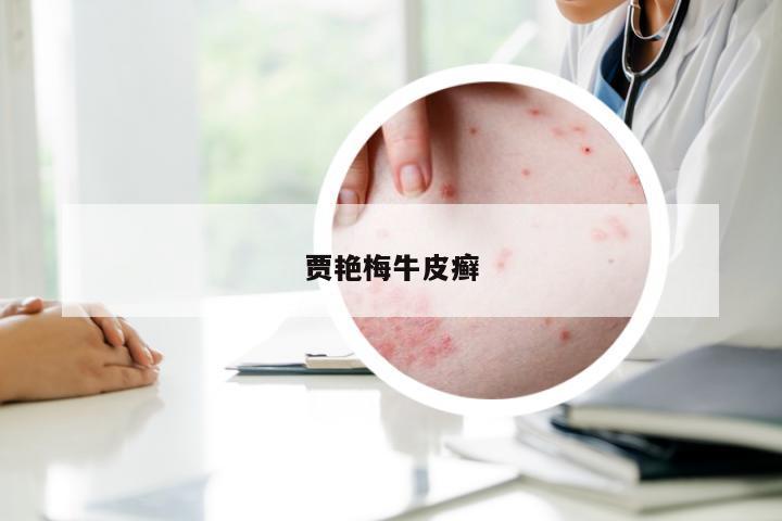 贾艳梅牛皮癣