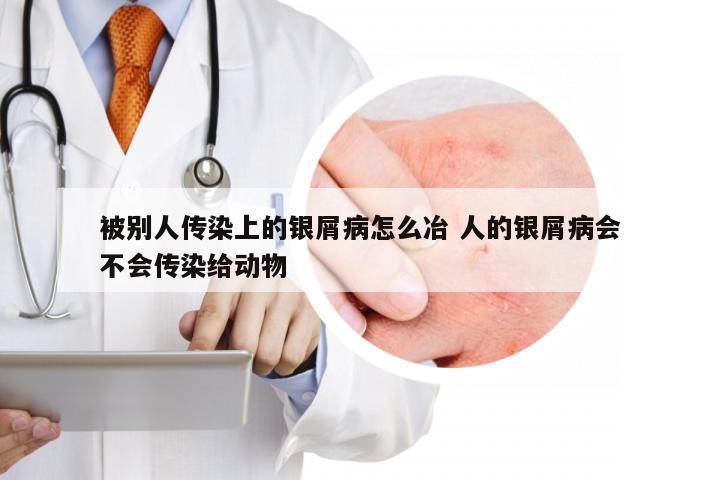 被别人传染上的银屑病怎么冶 人的银屑病会不会传染给动物