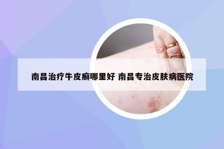 南昌治疗牛皮癣哪里好 南昌专治皮肤病医院