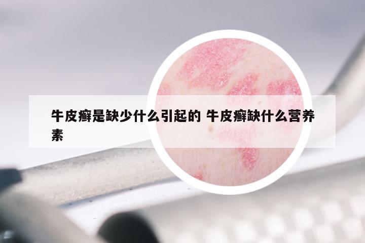 牛皮癣是缺少什么引起的 牛皮癣缺什么营养素