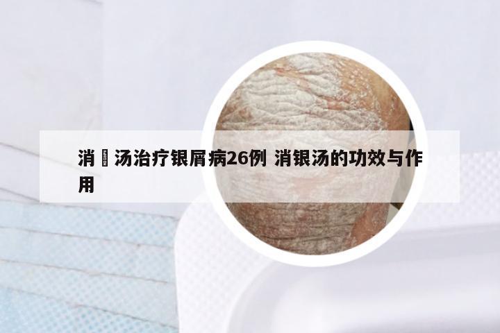 消疕汤治疗银屑病26例 消银汤的功效与作用