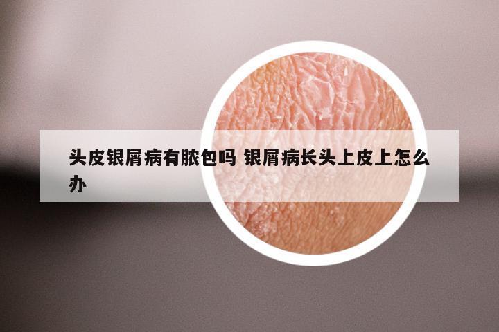 头皮银屑病有脓包吗 银屑病长头上皮上怎么办