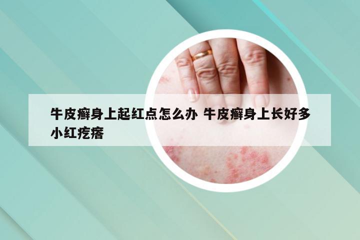 牛皮癣身上起红点怎么办 牛皮癣身上长好多小红疙瘩
