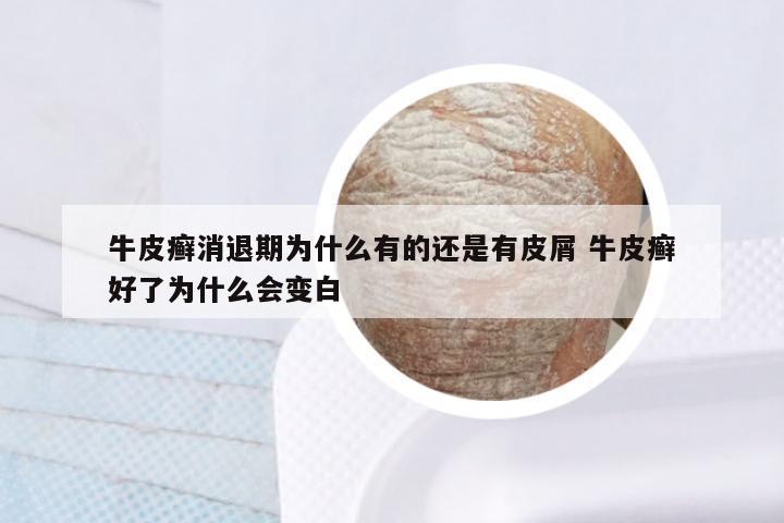 牛皮癣消退期为什么有的还是有皮屑 牛皮癣好了为什么会变白