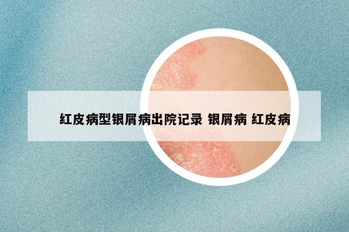红皮病型银屑病出院记录 银屑病 红皮病