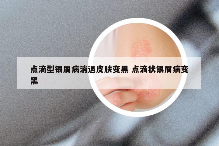 点滴型银屑病消退皮肤变黑 点滴状银屑病变黑