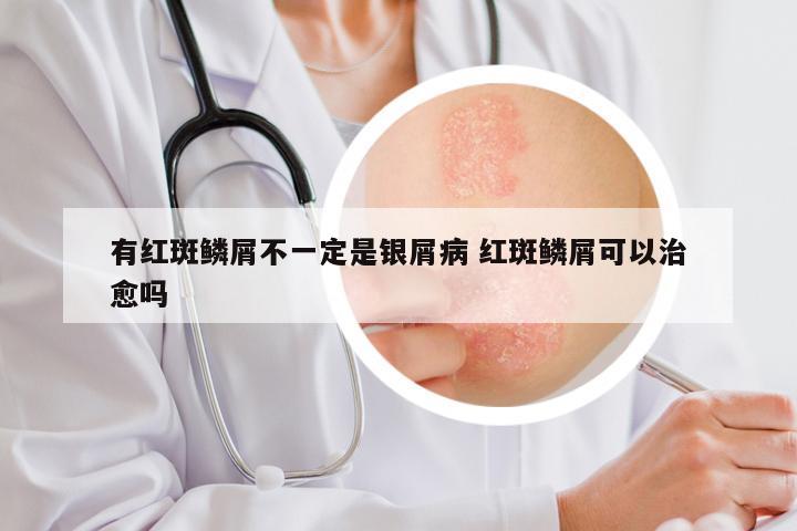 有红斑鳞屑不一定是银屑病 红斑鳞屑可以治愈吗