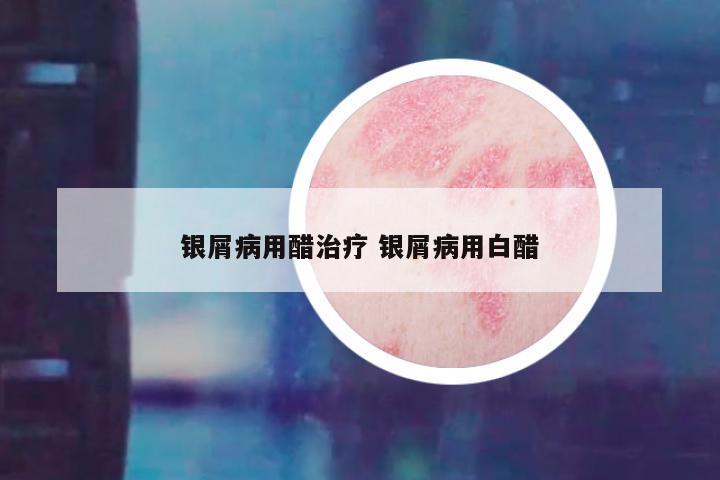 银屑病用醋治疗 银屑病用白醋