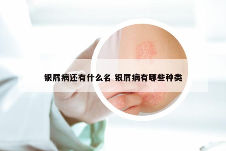银屑病还有什么名 银屑病有哪些种类