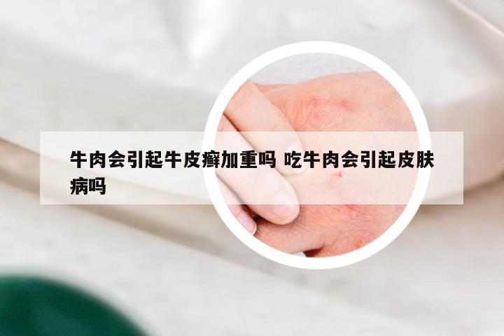 牛肉会引起牛皮癣加重吗 吃牛肉会引起皮肤病吗