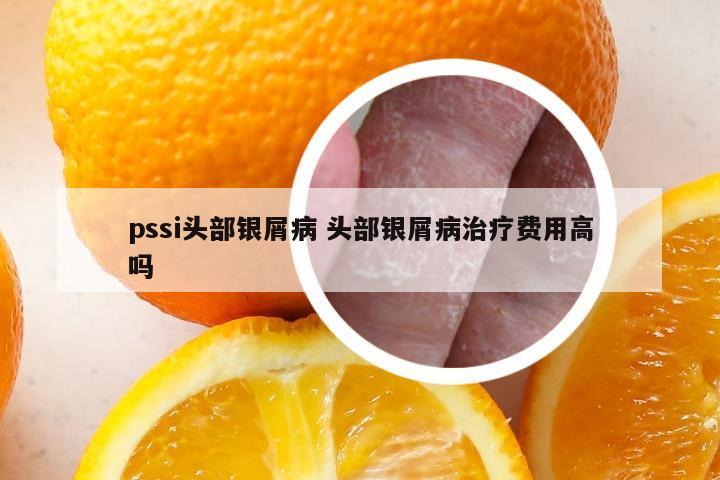 pssi头部银屑病 头部银屑病治疗费用高吗