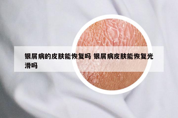 银屑病的皮肤能恢复吗 银屑病皮肤能恢复光滑吗