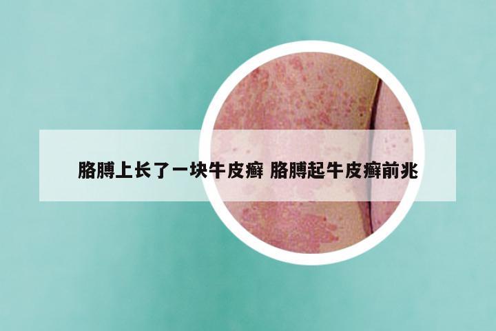 胳膊上长了一块牛皮癣 胳膊起牛皮癣前兆