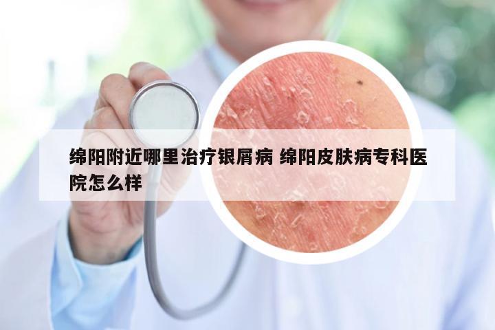 绵阳附近哪里治疗银屑病 绵阳皮肤病专科医院怎么样