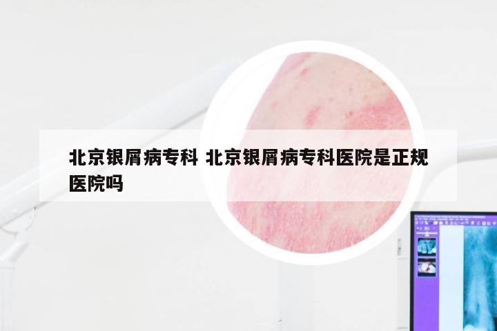北京银屑病专科 北京银屑病专科医院是正规医院吗