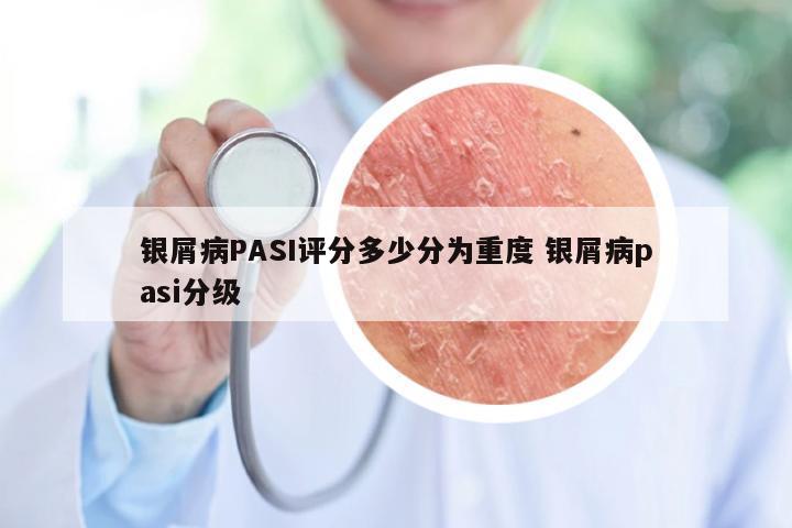 银屑病PASI评分多少分为重度 银屑病pasi分级