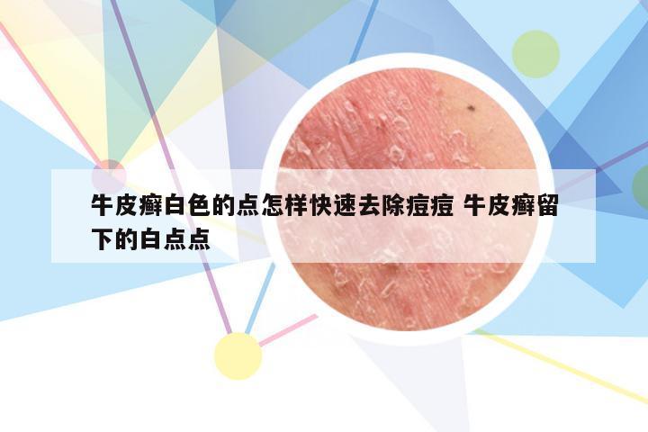 牛皮癣白色的点怎样快速去除痘痘 牛皮癣留下的白点点