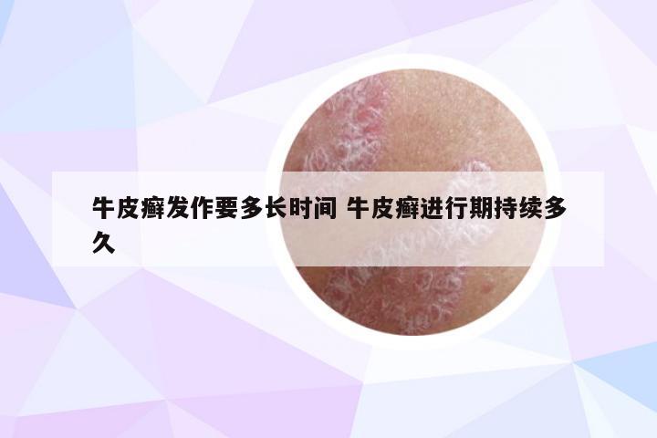 牛皮癣发作要多长时间 牛皮癣进行期持续多久