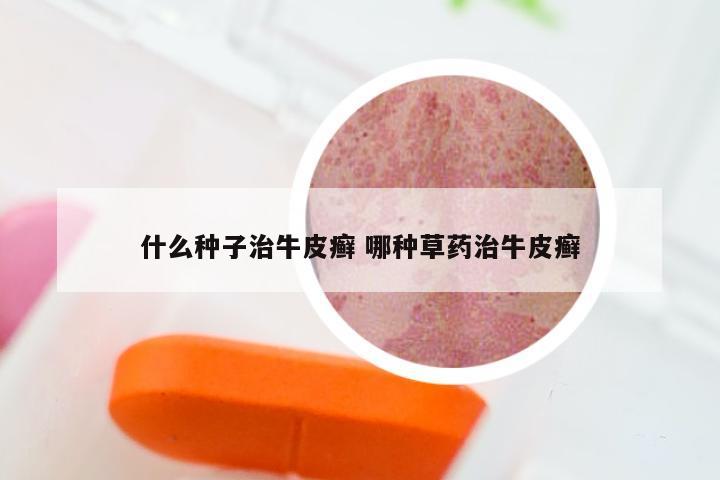 什么种子治牛皮癣 哪种草药治牛皮癣