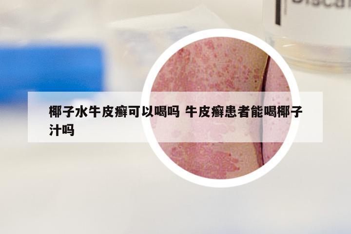 椰子水牛皮癣可以喝吗 牛皮癣患者能喝椰子汁吗