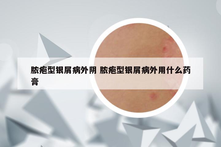 脓疱型银屑病外阴 脓疱型银屑病外用什么药膏
