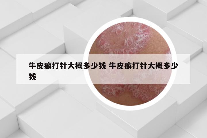 牛皮癣打针大概多少钱 牛皮癣打针大概多少钱