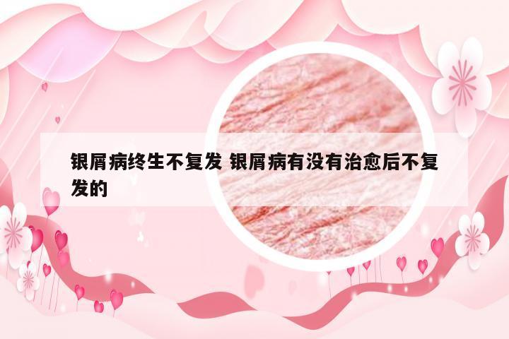银屑病终生不复发 银屑病有没有治愈后不复发的