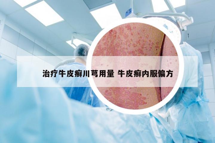 治疗牛皮癣川芎用量 牛皮癣内服偏方